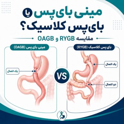 مینی بایپس بهتر است یا بایپس کلاسیک
