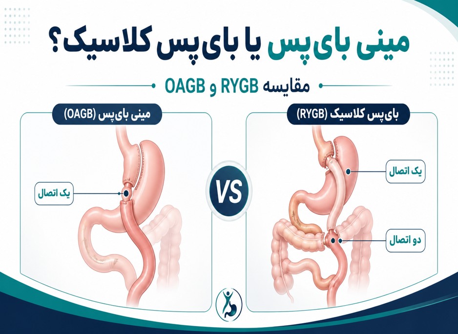 مینی بایپس معده بهتر است یا بایپس کلاسیک
