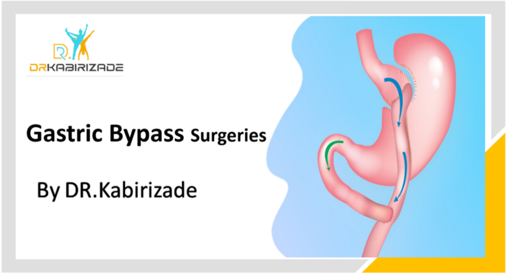 Gastric Bypass By Dr.kabirizade