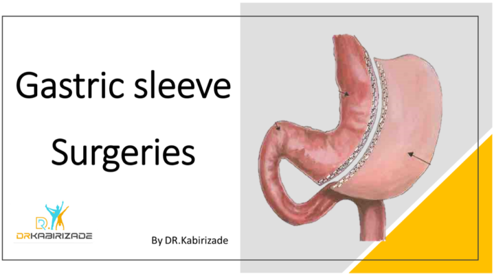 gastric sleeve surgery by Dr. kabirizade