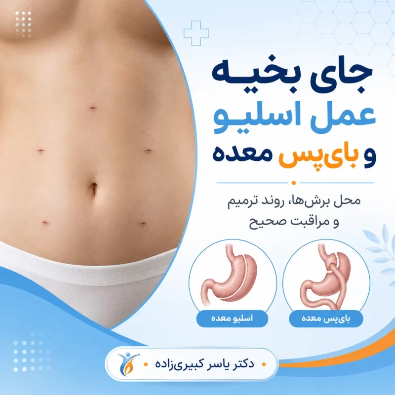 جای زخم و بخیه بعد از اسلیو و بایپس معده - مرداد 1405