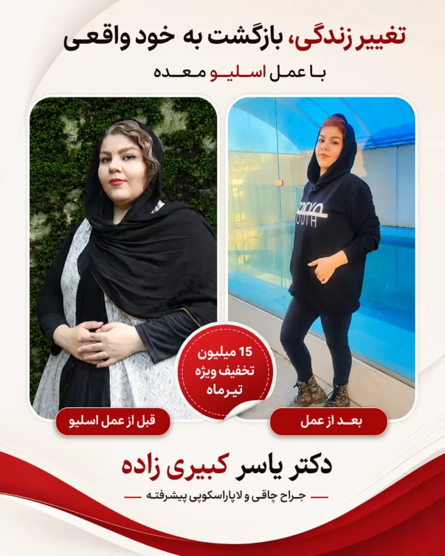 عمل اسلیو معده بعد از زایمان 15 نتیجه بعد از اسلیو و بایپس افرادی که توسط دکتر یسار کبیری زاده عمل شده اند