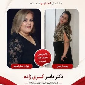 نتیجه بعد از اسلیو و بایپس افرادی که توسط دکتر یسار کبیری زاده عمل شده اند