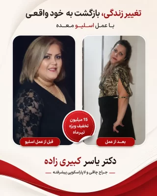 نتیجه بعد از اسلیو و بایپس افرادی که توسط دکتر یسار کبیری زاده عمل شده اند