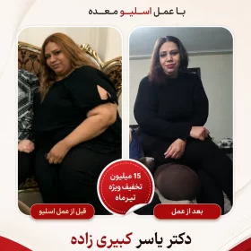 نتیجه بعد از اسلیو و بایپس افرادی که توسط دکتر یسار کبیری زاده عمل شده اند