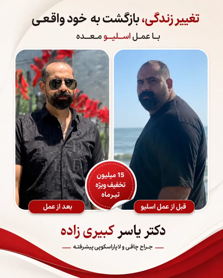 تجربه از عمل اسلیو معده