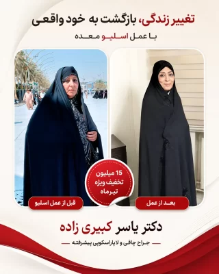 نتیجه بعد از اسلیو و بایپس افرادی که توسط دکتر یسار کبیری زاده عمل شده اند
