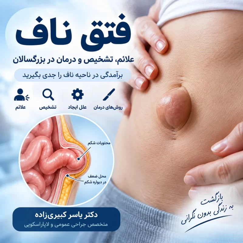 فتق ناف